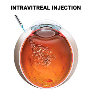 Intravitreal Injection Vitreous Retina Macula Consultants Of New York