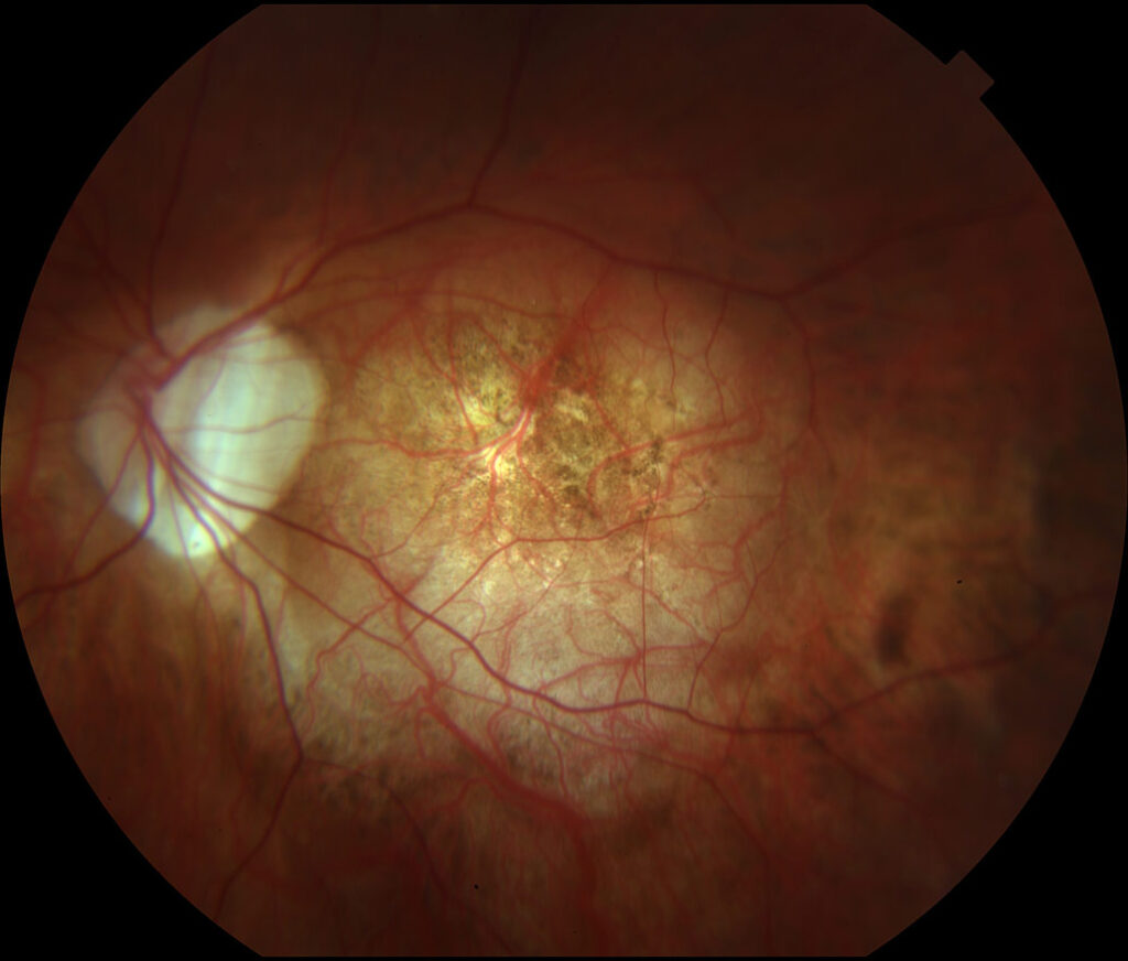 myopic-degeneration-vitreous-retina-macula-consultants-of-new-york