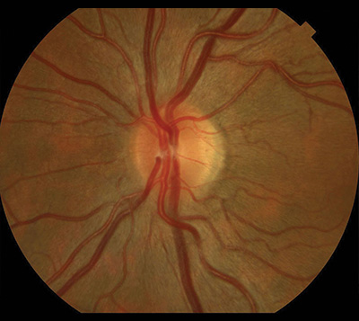 Optic Nerve