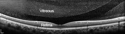 VITREOUS-OCT