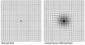 Central Serous Chorioretinopathy Treatment - New York Retina Specialists