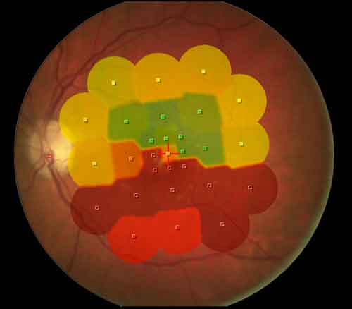 Microperimetry