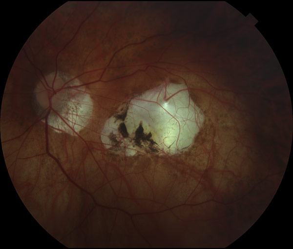 Myopic Atrophy