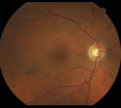 Retina