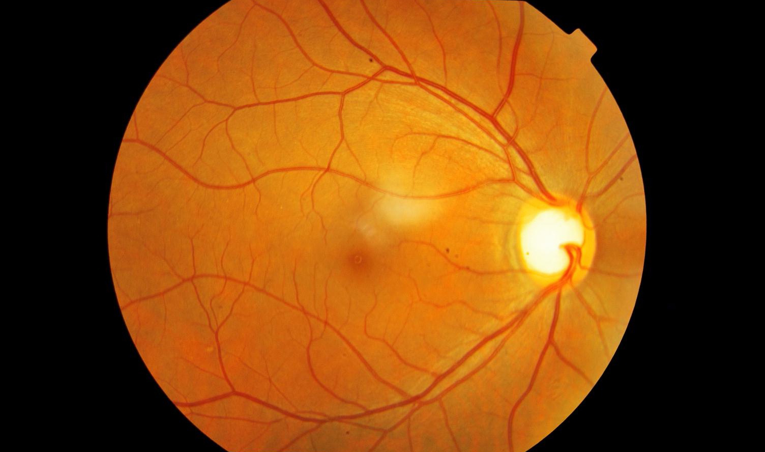 Angle-Closure Glaucoma