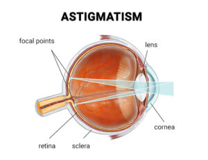 Astigmatism Treatments in NYC - Best Eye Doctors in New York