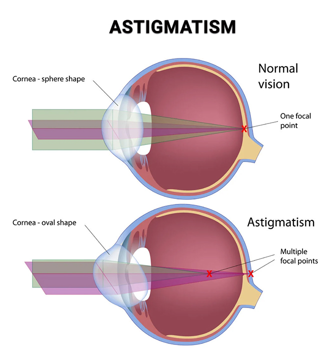 Refractive Errors - Vitreous Retina Macula Consultants Of New York