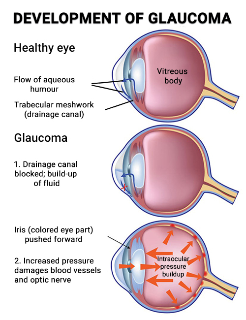 Development of Glaucoma