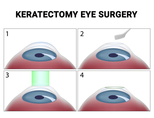 Keratectomy Eye Surgery