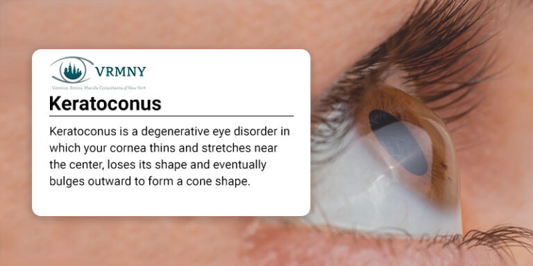 Corneal Cross Linking for Keratoconus NYC - Ophthalmologists New York