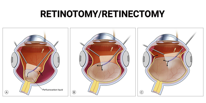 Retinotomy/Retinectomy