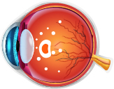 Age Related Macular Degeneration