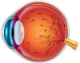 Retinal Vein Occlusion